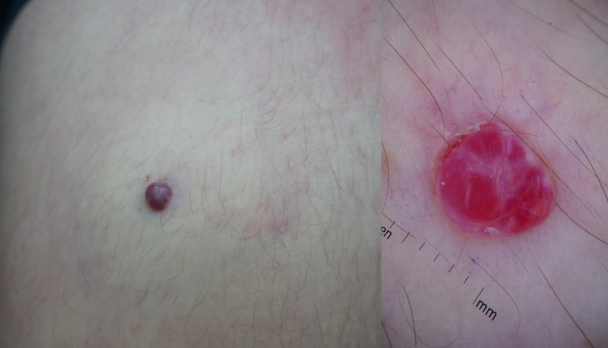 Article Feature Image - Pyogenic Granuloma