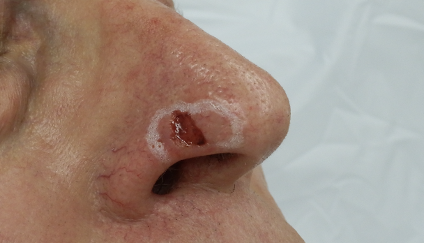 inset ulcer on nose